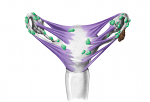 Leicht ausgeprägte Endometriose bei einer Frau